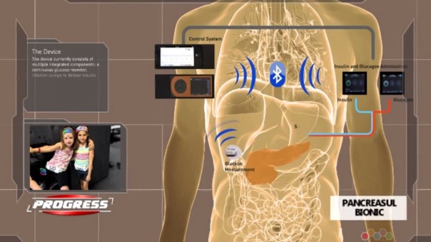 pancreasul bionic